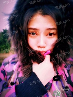 切開雙眼皮消腫過程圖_切開雙眼皮恢復(fù)過程圖 切開雙眼皮消腫過程圖_切開雙眼皮恢復(fù)過程圖