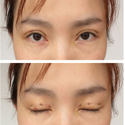 三點雙眼皮恢復過程圖_韓式三點雙眼皮多久恢復自然 三點雙眼皮恢復過程圖_韓式三點雙眼皮多久恢復自然