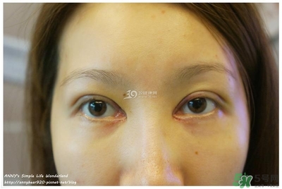 重瞼術(shù)多久能完全消腫 重瞼術(shù)恢復(fù)過(guò)程圖 重瞼術(shù)多久能完全消腫 重瞼術(shù)恢復(fù)過(guò)程圖