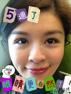 重瞼術(shù)是什么？重瞼術(shù)是永久的嗎？