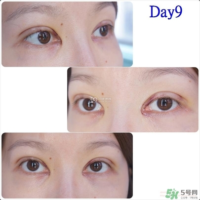 重瞼術(shù)多久能完全消腫 重瞼術(shù)恢復(fù)過(guò)程圖 重瞼術(shù)多久能完全消腫 重瞼術(shù)恢復(fù)過(guò)程圖