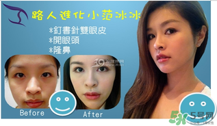 重瞼術(shù)是什么？重瞼術(shù)是永久的嗎？