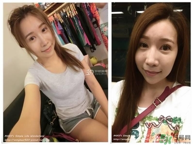 重瞼術(shù)多久能完全消腫 重瞼術(shù)恢復(fù)過(guò)程圖 重瞼術(shù)多久能完全消腫 重瞼術(shù)恢復(fù)過(guò)程圖