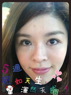 重瞼術(shù)是什么？重瞼術(shù)是永久的嗎？