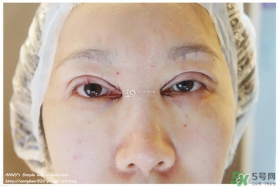 重瞼術(shù)多久能完全消腫 重瞼術(shù)恢復(fù)過(guò)程圖 重瞼術(shù)多久能完全消腫 重瞼術(shù)恢復(fù)過(guò)程圖