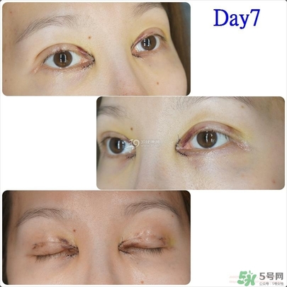 重瞼術(shù)多久能完全消腫 重瞼術(shù)恢復(fù)過(guò)程圖 重瞼術(shù)多久能完全消腫 重瞼術(shù)恢復(fù)過(guò)程圖