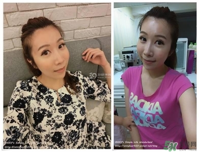 重瞼術(shù)多久能完全消腫 重瞼術(shù)恢復(fù)過(guò)程圖 重瞼術(shù)多久能完全消腫 重瞼術(shù)恢復(fù)過(guò)程圖