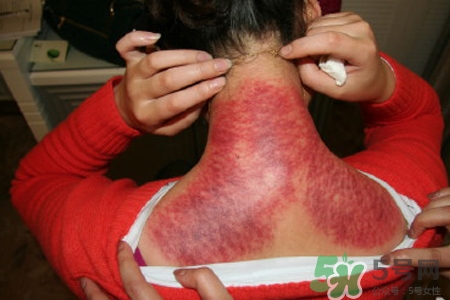 刮痧可以治頸椎病嗎？刮痧能治療頸椎病嗎？