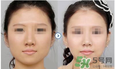 打瘦臉針疼不疼？打瘦臉針的注意事項(xiàng)