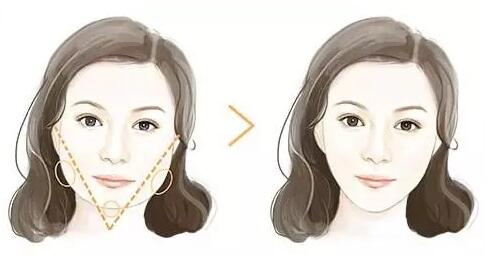 瘦臉針適合什么人打？瘦臉針適合什么臉型？