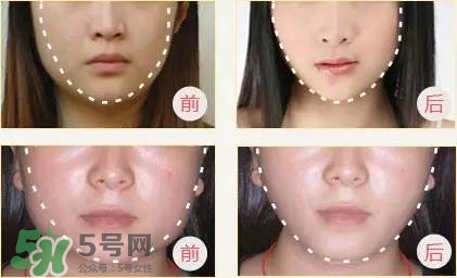 打完瘦臉針多久可以化妝？打完瘦臉針的反應(yīng)