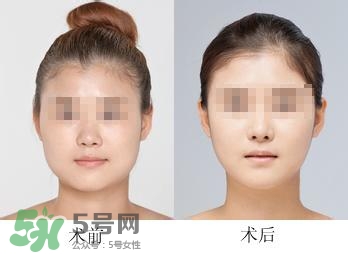 打瘦臉針能喝酒嗎？打瘦臉針能吃海鮮嗎？