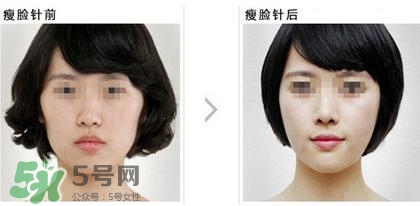 打瘦臉針能喝酒嗎？打瘦臉針能吃海鮮嗎？