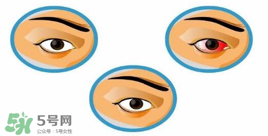 紅眼病用什么眼藥水好？紅眼病吃什么好得快