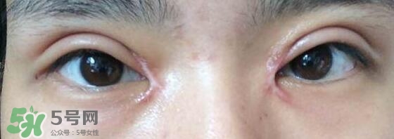 眼角增生是什么意思？眼角增生了怎么辦？