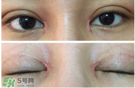 眼角增生是什么意思？眼角增生了怎么辦？