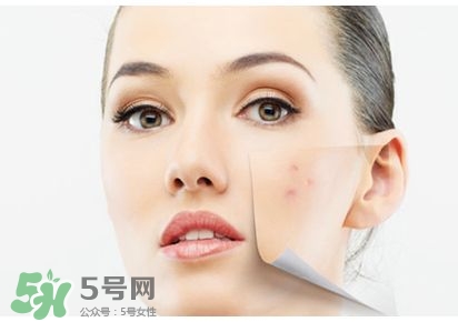 祛痘好方法 祛痘小妙招 祛痘好方法 祛痘小妙招