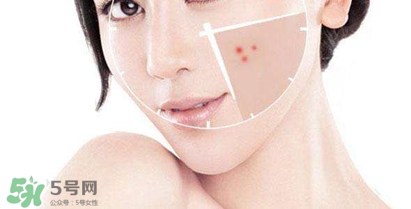 祛痘好方法 祛痘小妙招 祛痘好方法 祛痘小妙招