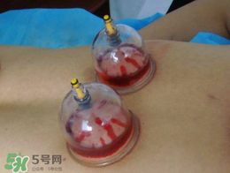 春天可以拔火罐嗎？春天適合拔火罐嗎？