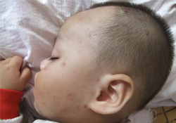 有水痘的寶寶能不能沾水？長(zhǎng)水痘可以碰水嗎？