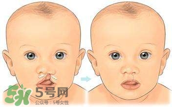 兔唇能檢查出來嗎？兔唇能完全修復(fù)嗎？