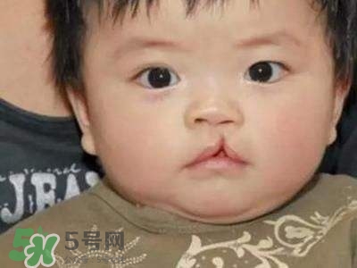 兔唇可以治嗎？兔唇修補(bǔ)術(shù)