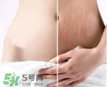 妊娠紋怎么長(zhǎng)在大腿上了？妊娠紋會(huì)不會(huì)長(zhǎng)在大腿上？