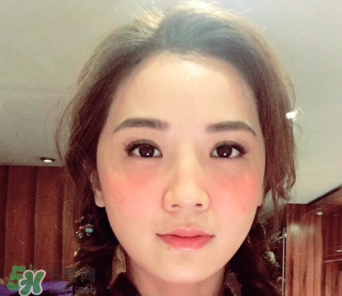 夏天可以點(diǎn)痣嗎？夏天點(diǎn)痣后要注意什么？