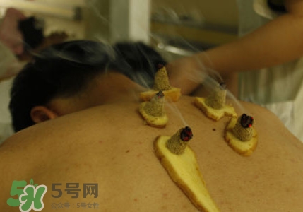 三伏灸有用嗎？2017年三伏艾灸時間