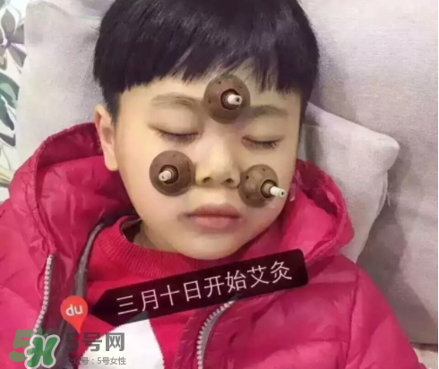 艾灸貼可以治咳嗽嗎？艾灸貼可以治退燒嗎？