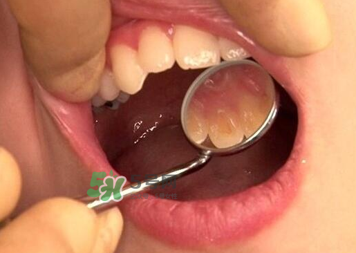 三伏天可以拔牙嗎嗎?三伏天拔牙好嗎？