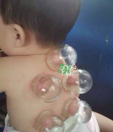 拔火罐后顏色多久消失？拔火罐印子多久能消除？