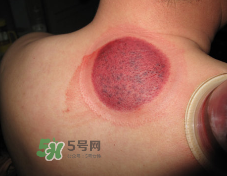 三伏天拔罐后多久可以洗澡？三伏天拔罐后注意事項