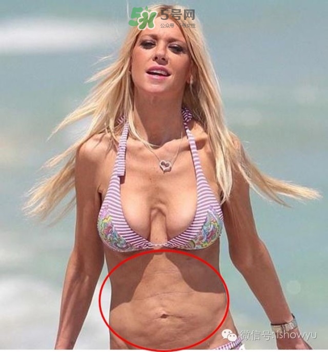 酷塑溶脂效果對(duì)比圖片 酷塑溶脂全過(guò)程記錄 酷塑溶脂效果對(duì)比圖片 酷塑溶脂全過(guò)程記錄