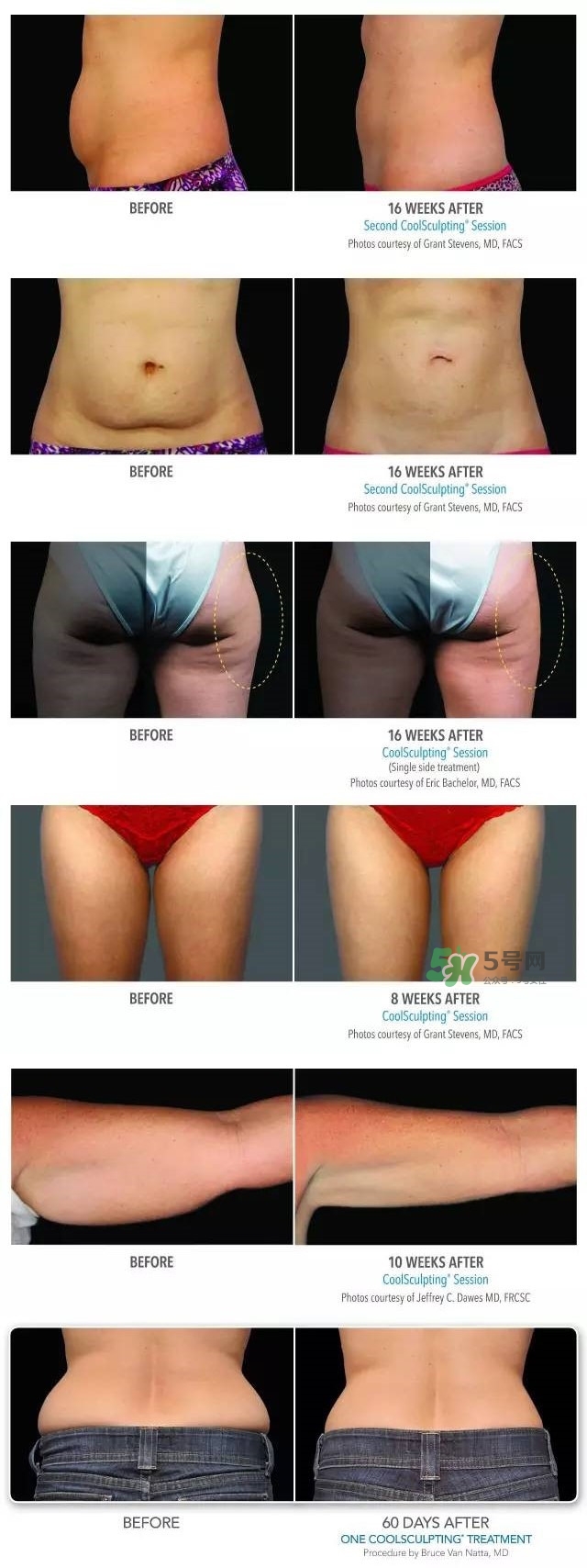 酷塑溶脂效果對(duì)比圖片 酷塑溶脂全過(guò)程記錄 酷塑溶脂效果對(duì)比圖片 酷塑溶脂全過(guò)程記錄