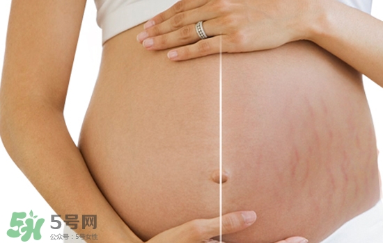 妊娠紋在左邊生男或女？怎么從妊娠紋看男女？