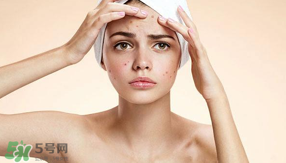 長痘長閉口怎么辦？長痘長閉口是什么原因？