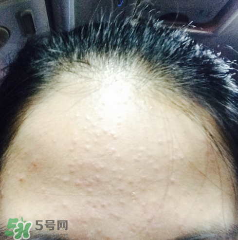 長痘長閉口怎么辦？長痘長閉口是什么原因？