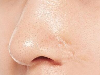 角栓是什么 角栓是怎么形成的 角栓是什么 角栓是怎么形成的