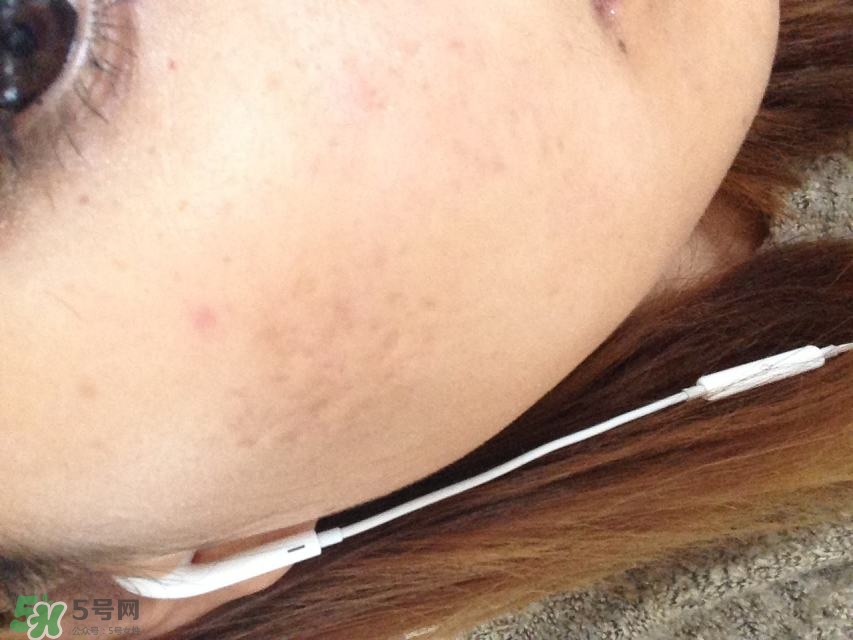 痘印是怎樣形成的 痘印形成的原因 痘印是怎樣形成的 痘印形成的原因