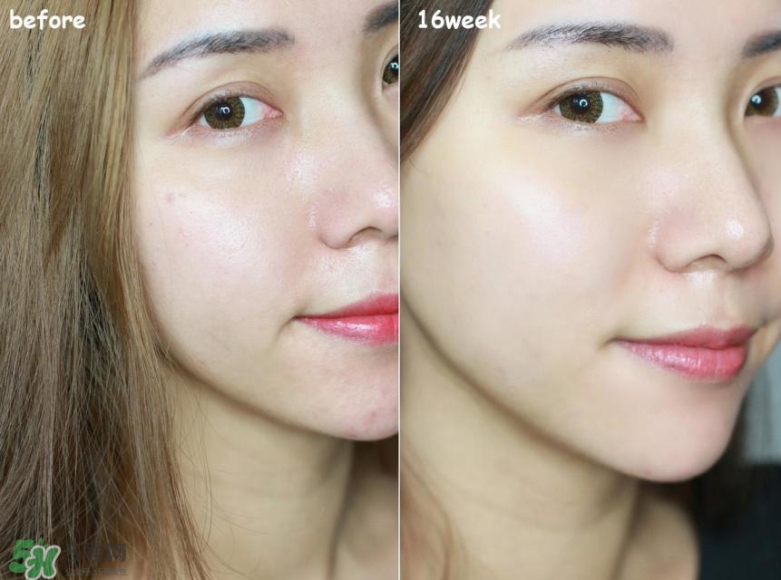 痘印是怎樣形成的 痘印形成的原因 痘印是怎樣形成的 痘印形成的原因