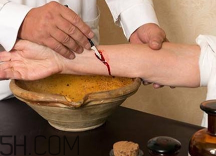 放血療法適合任何人嗎？放血療法是如何退出歷史舞臺的