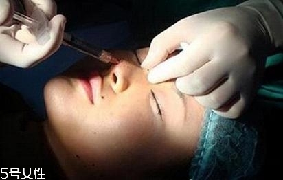 玻尿酸隆鼻多久能洗臉？玻尿酸隆鼻會越來越寬