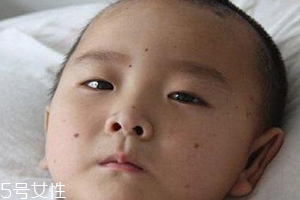 痣什么情況下會轉變?yōu)榱?？點痣不可取