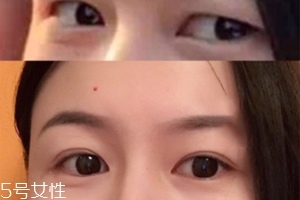 內(nèi)雙怎么進(jìn)化成雙眼皮？全是雙眼皮貼的功勞