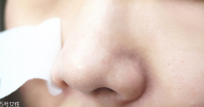 怎樣安全去除黑頭 安全去除黑頭的方法 怎樣安全去除黑頭 安全去除黑頭的方法