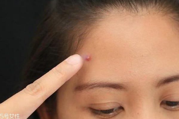 痘印顏色加深是怎么回事？補水還不夠