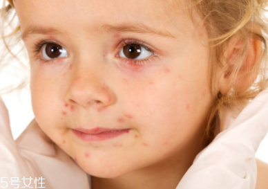 痘印顏色加深是怎么回事？補水還不夠