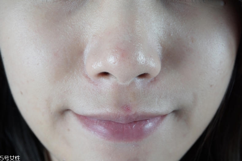 泊舒清痘霜有用嗎 泊舒清痘能力實(shí)測(cè) 泊舒清痘霜有用嗎 泊舒清痘能力實(shí)測(cè)