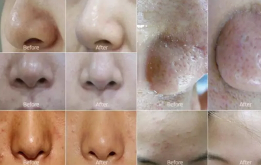 小氣泡毛孔會(huì)變大嗎？小氣泡清潔可以去黑頭嗎